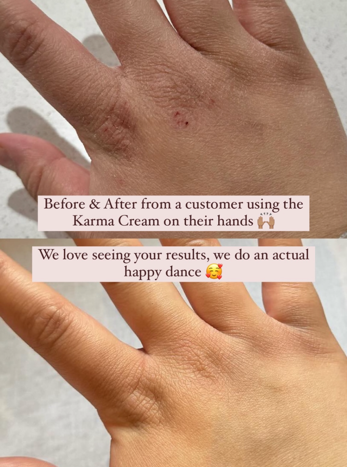 Before and after comparison of a hand using Karma Cream, showing skin texture improvement.