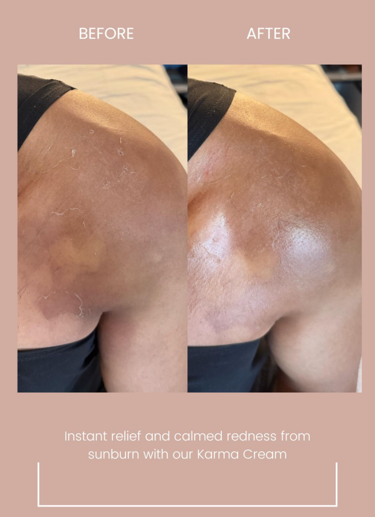 Before and after comparison of a sunburned shoulder healing with text about Karma Cream. instant relief and calm redness in skin