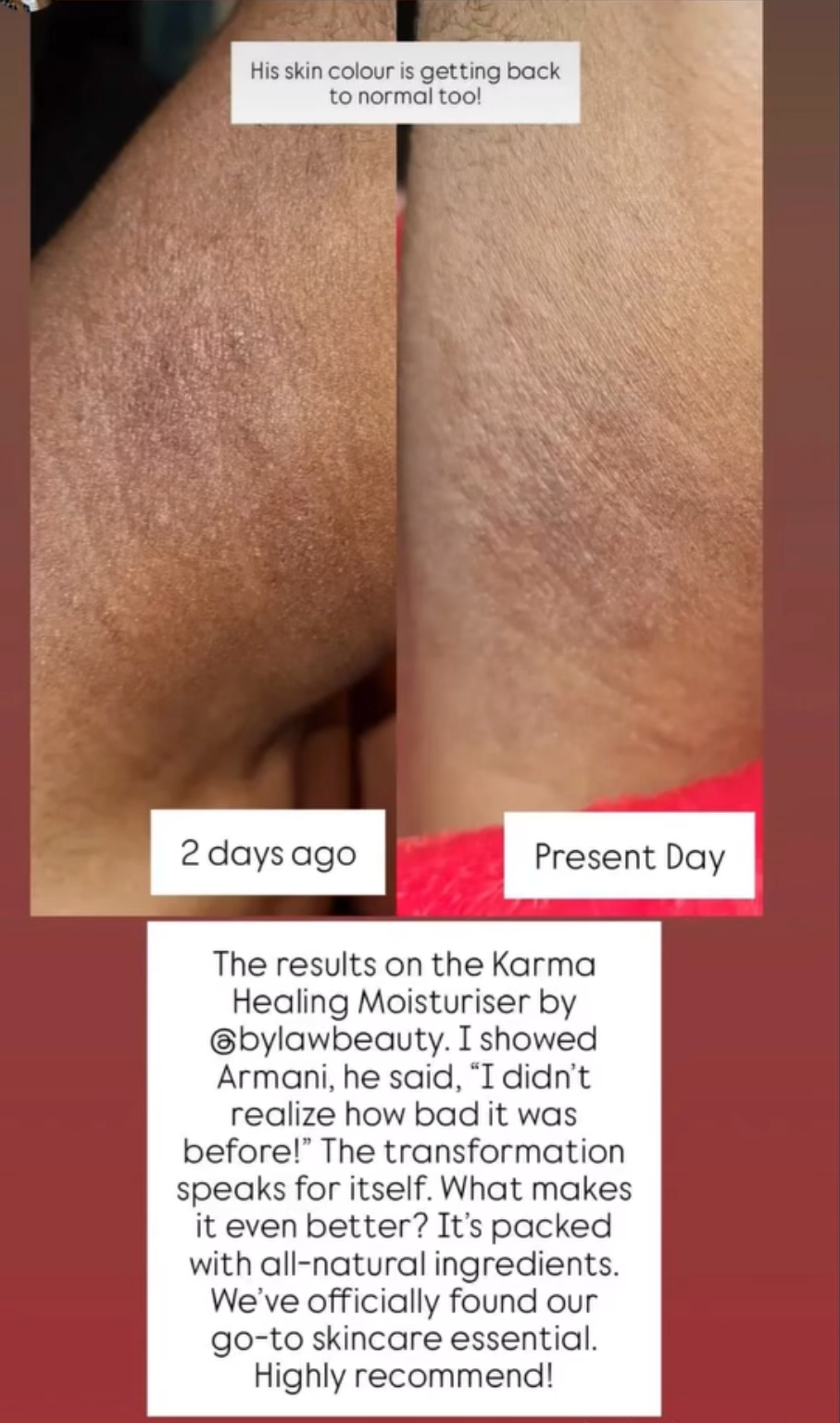 Before and after comparison of skin texture with text about a skincare product. 2 days improvement in eczema and skin discolouration. 
